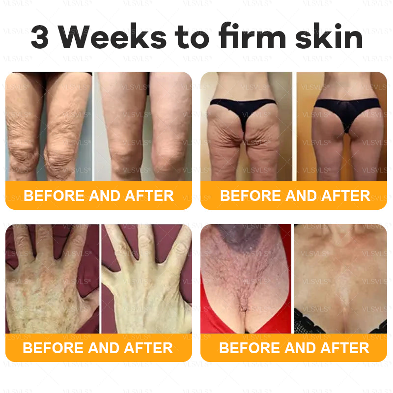 VLSVLS® Bee Venom Comprehensive Cream  👑👑👑LAST DAY 80% OFF (Sagging Skin, Fine Lines, Loss of Firmness, Flat Bust, Drooping Hips, and More💎)