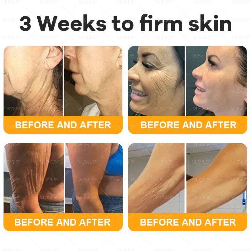 VLSVLS® Bee Venom Comprehensive Cream  👑👑👑LAST DAY 80% OFF (Sagging Skin, Fine Lines, Loss of Firmness, Flat Bust, Drooping Hips, and More💎)