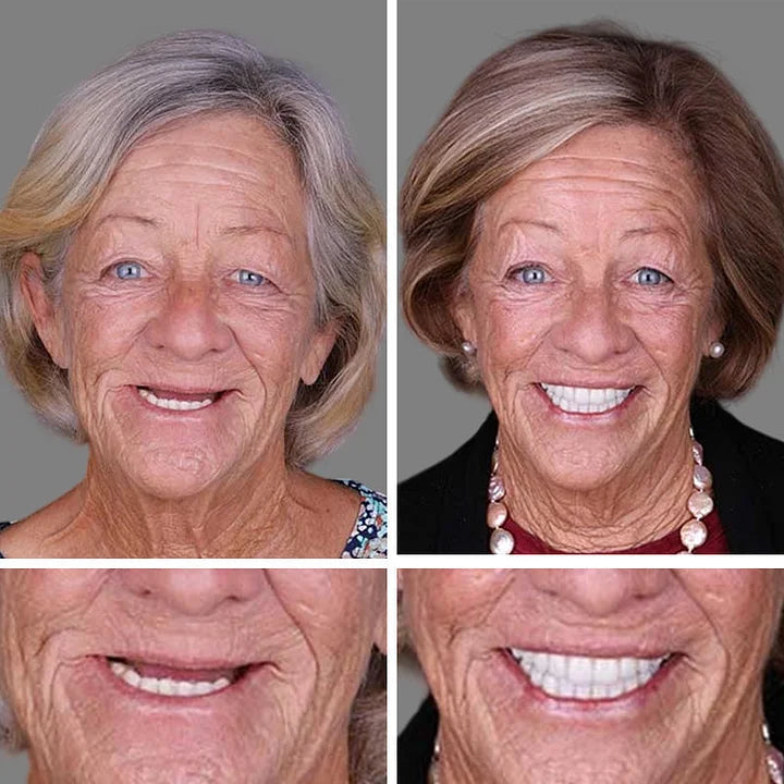 Ends Today: 70% OFF! ⏰70% OFF! EETTSY™ Medical Full Denture with Strong Suctiond Custom-Fit Full Functional Dentures🦷Obtain American Dental Association (ADA) Certification